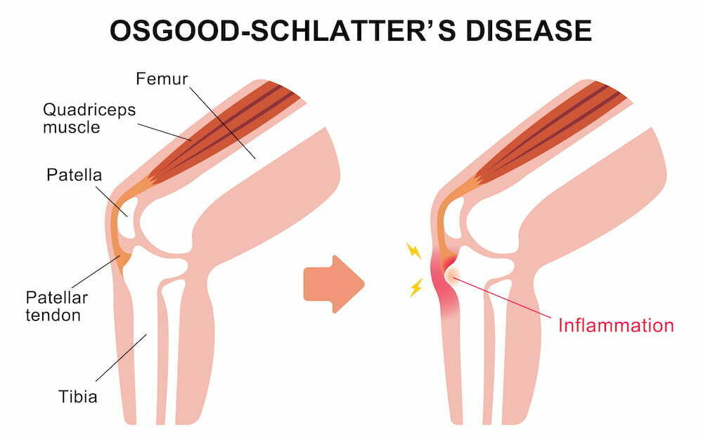 Osgood–Schlatter Disease treatment.