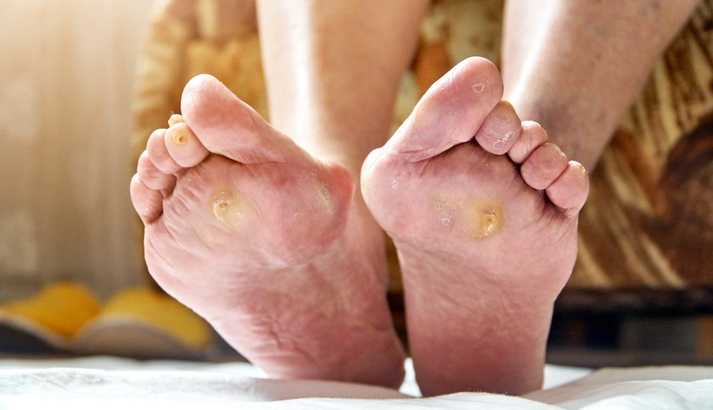 Diabetic foot ulcers.