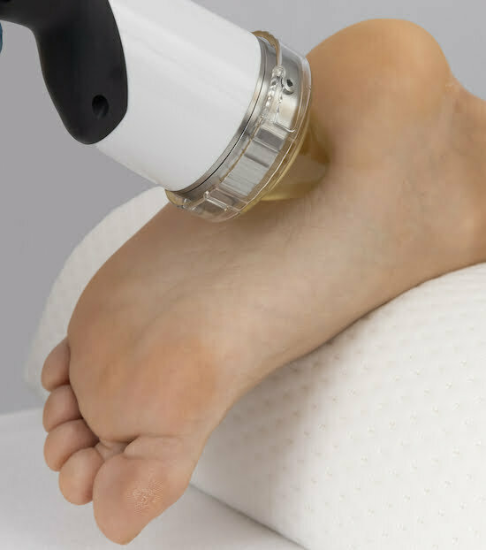 Stress fracture treatment using shockwave.